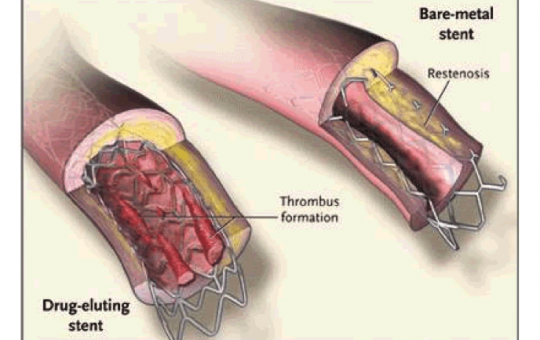 picture MENGENAL LEBIH DEKAT STENT JANTUNG